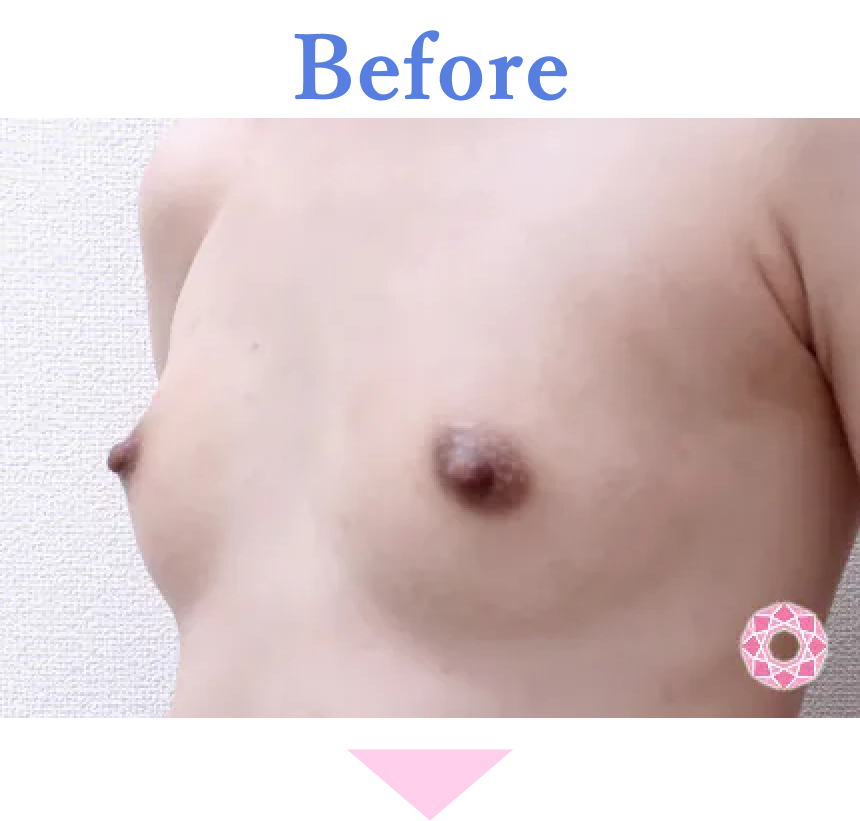年代：20代 施術名：バッグによる豊胸 施術前 拡大画像｜【公式】東京形成美容外科