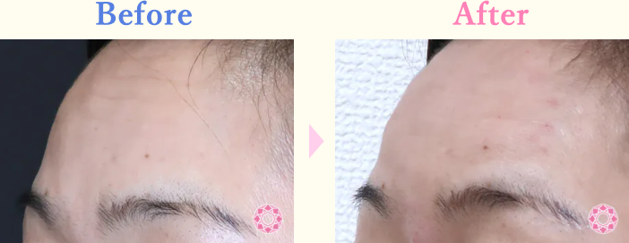 年代：50代 施術名：シワ取り（ヒアルロン酸） 施術前後｜【公式】東京形成美容外科