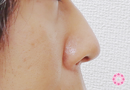 年代：30代 施術名：小鼻縮小 施術前｜東京形成美容外科