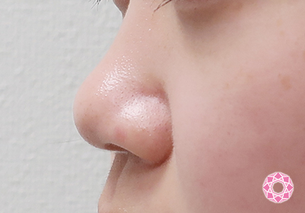 年代：10代 施術名：小鼻縮小 施術前｜東京形成美容外科