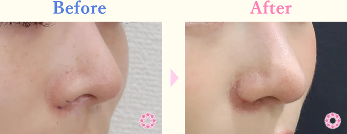 年代：20代 施術名：小鼻縮小 施術前後｜【公式】東京形成美容外科