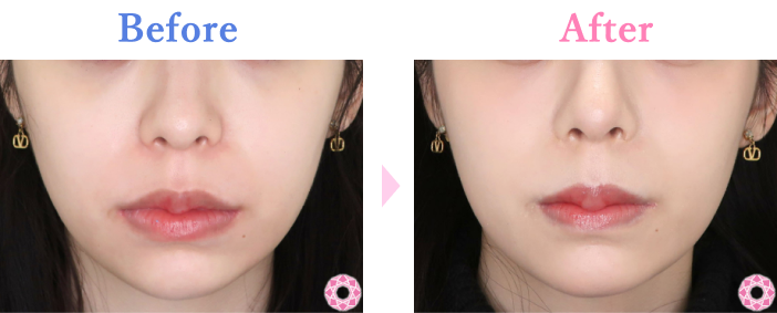 カベリン（脂肪溶解）の症例写真 施術前後