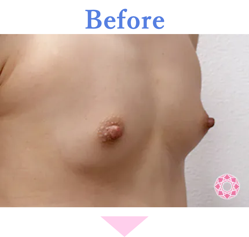 年代：20代 施術名：バッグによる豊胸 施術前 拡大画像｜【公式】東京形成美容外科