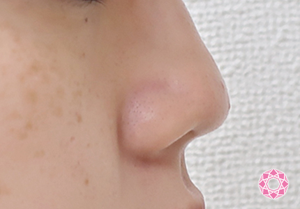 年代：20代 施術名：鼻尖PCLドーム 施術前｜東京形成美容外科