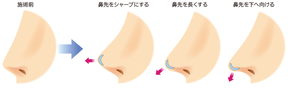 耳介軟骨移植（鼻尖形成）