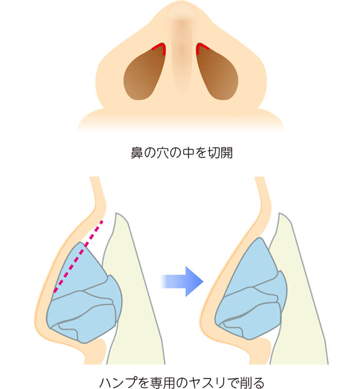 ワシ鼻・カギ鼻修正の方法