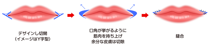 口角挙上（スマイルリップ）は、デザインし切開 (イメージはY字型) 口角が挙がるように 筋肉を持ち上げ、 余分な皮膚は切除 縫合します。