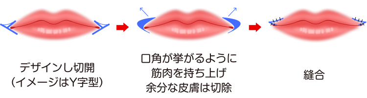 口角挙上（スマイルリップ）は、デザインし切開 (イメージはY字型) 口角が挙がるように 筋肉を持ち上げ、 余分な皮膚は切除 縫合します。