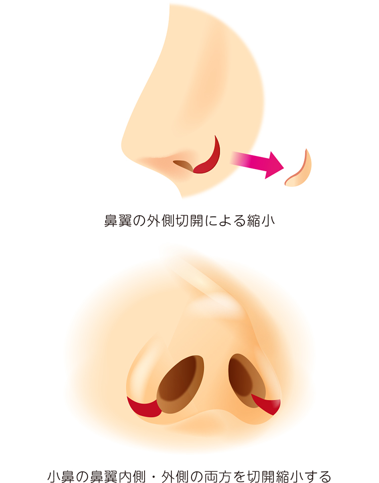 小鼻切開のイラスト