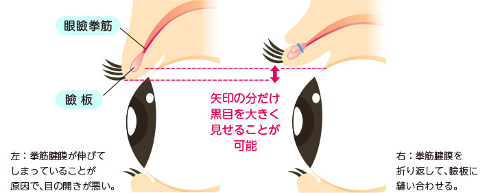 挙筋腱膜を折り返して瞼板に縫合する