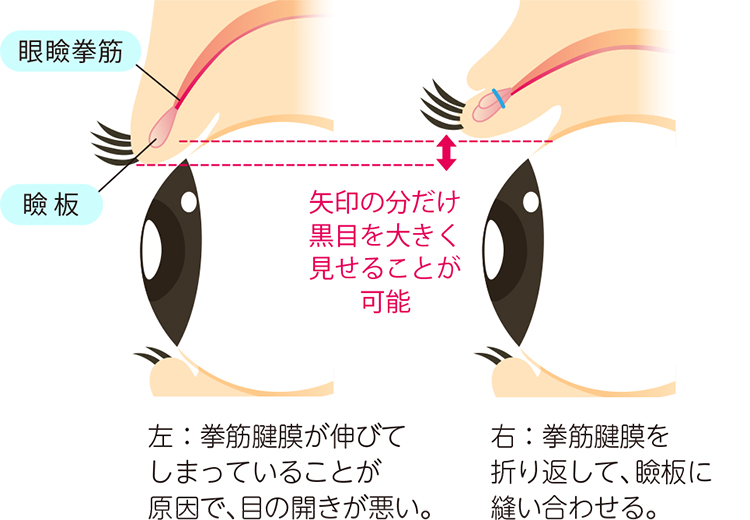 挙筋腱膜を折り返して瞼板に縫合する