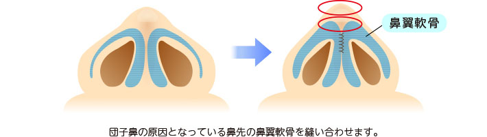 団子鼻の原因である鼻先の鼻翼軟骨を縫合