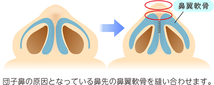 団子鼻の原因である鼻先の鼻翼軟骨を縫合