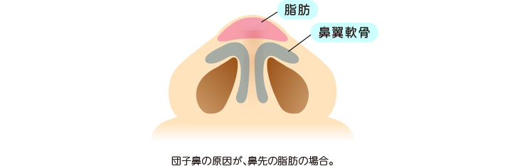 団子鼻の原因が鼻先の脂肪の場合