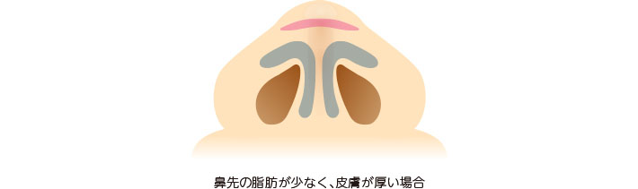 鼻先の脂肪が少なく、皮膚が厚い場合