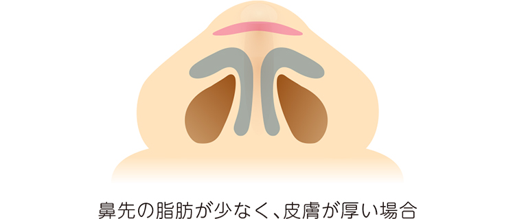 鼻先の脂肪が少なく、皮膚が厚い場合
