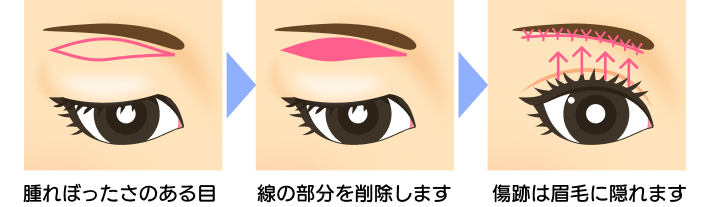 腫れぼったさのある目の上部分を削除し、傷跡は眉毛に隠す