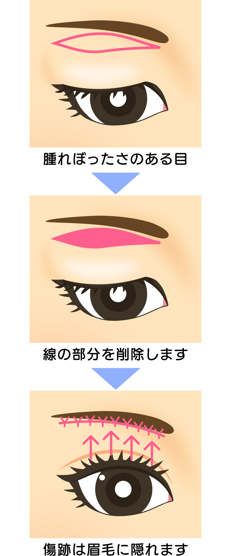 腫れぼったさのある目の上部分を削除し、傷跡は眉毛に隠す