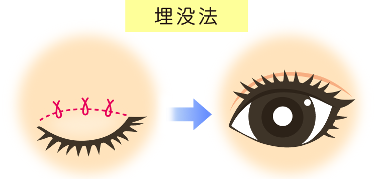 埋没法