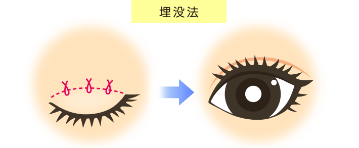 埋没法