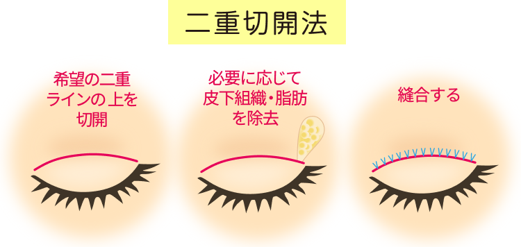 二重切開法
