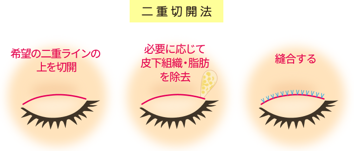 二重切開法