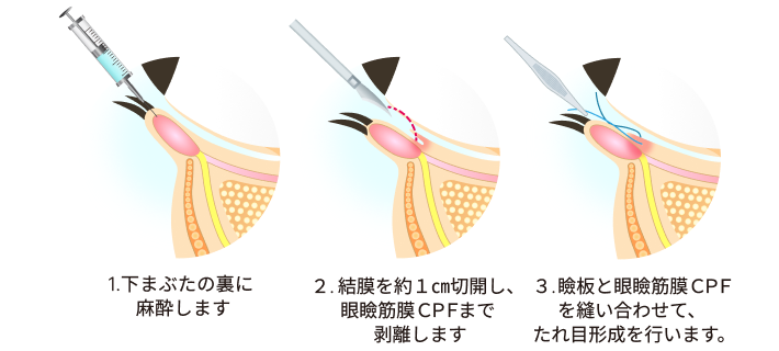 たれ目形成方法