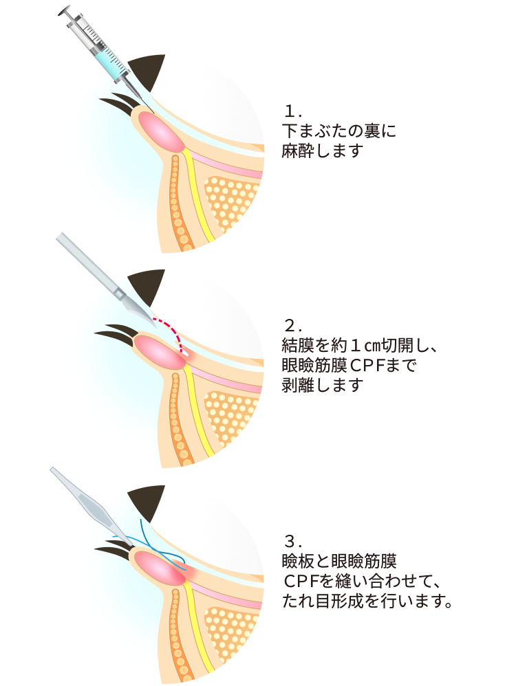 たれ目形成方法