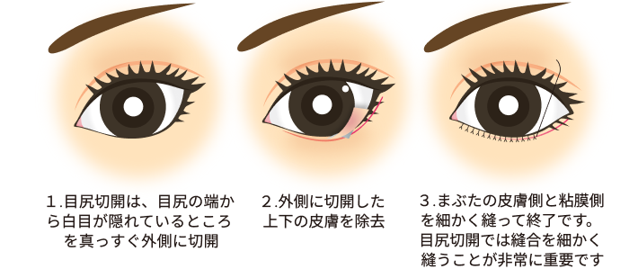 目尻切開方法