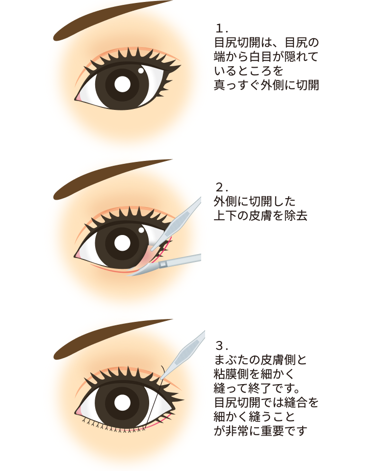 目尻切開方法