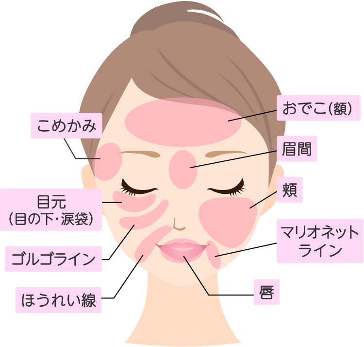 顔の脂肪注入の対象部位を説明するイラスト