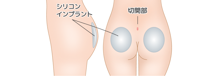 シリコンインプラント