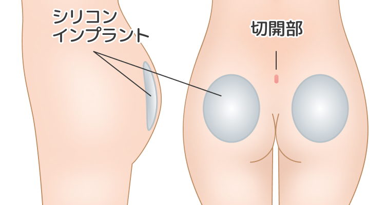 シリコンインプラント