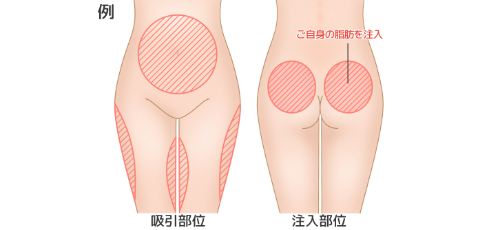 脂肪吸引部位及び脂肪注入部位