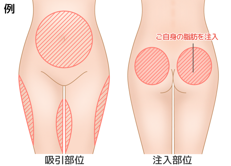 脂肪吸引部位及び脂肪注入部位