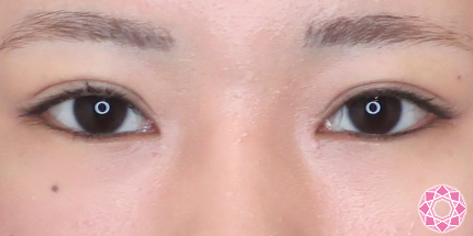年代：10代 施術名：目頭切開法 施術後 拡大画像｜【公式】東京形成美容外科