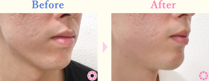 年代：20代 施術名：1DayクイックEライン 施術前後｜【公式】東京形成美容外科