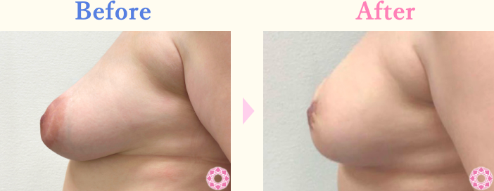 年代：40代 施術名：乳輪縮小 施術前後｜【公式】東京形成美容外科