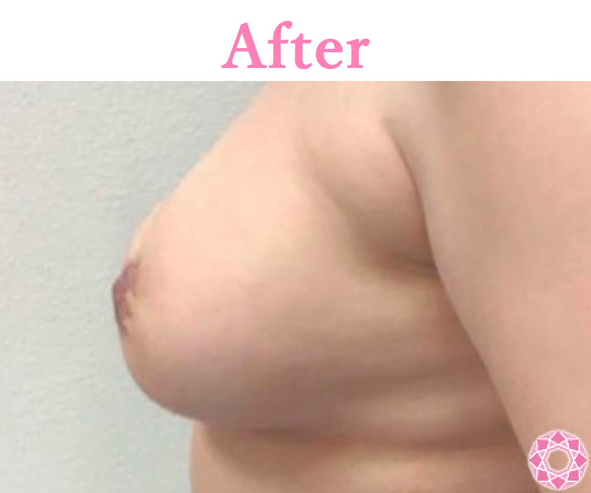 年代：40代 施術名：乳輪縮小 施術後 拡大画像｜【公式】東京形成美容外科