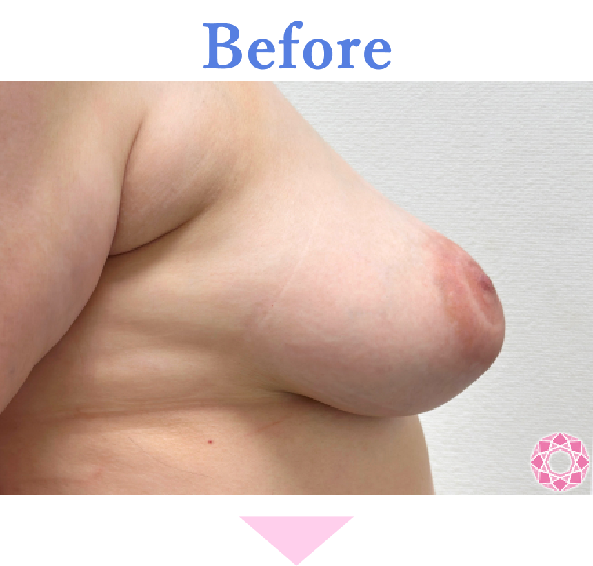 年代：40代 施術名：乳輪縮小 施術前 拡大画像｜【公式】東京形成美容外科