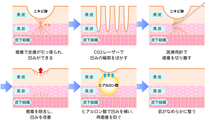 ニキビ跡・クレーターができる原因とサブシジョンの仕組み