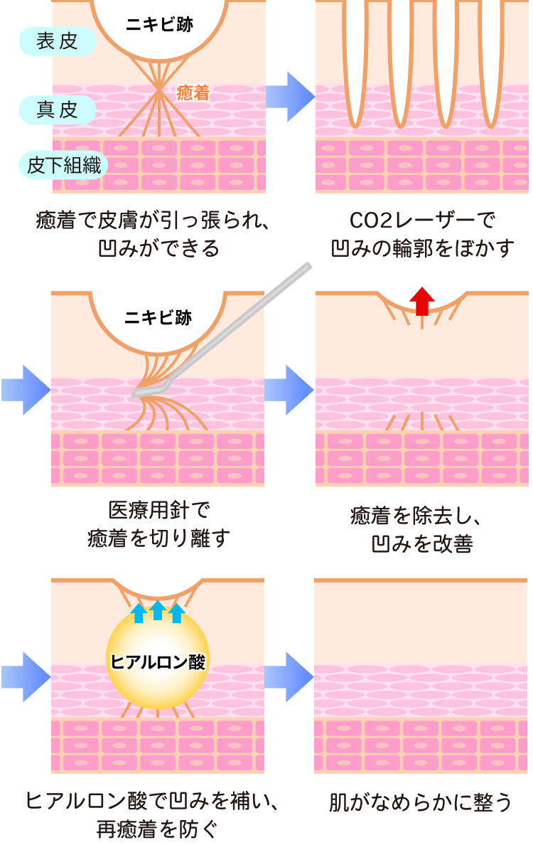 ニキビ跡・クレーターができる原因とサブシジョンの仕組み
