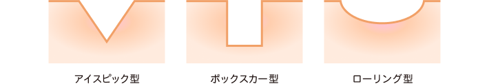 サブシジョンが適用されるのは「ローリングタイプ」のニキビ跡
