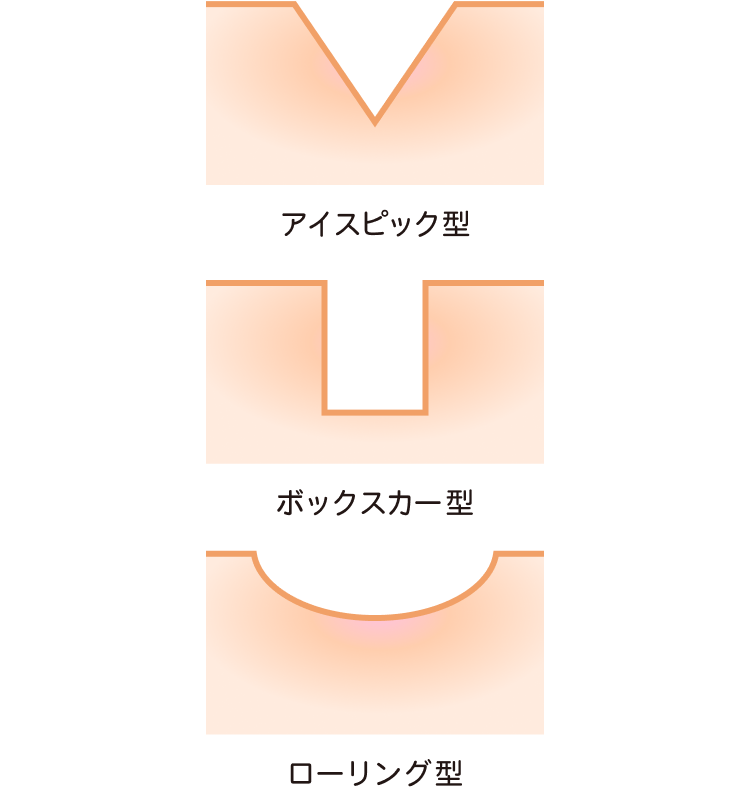 サブシジョンが適用されるのは「ローリングタイプ」のニキビ跡