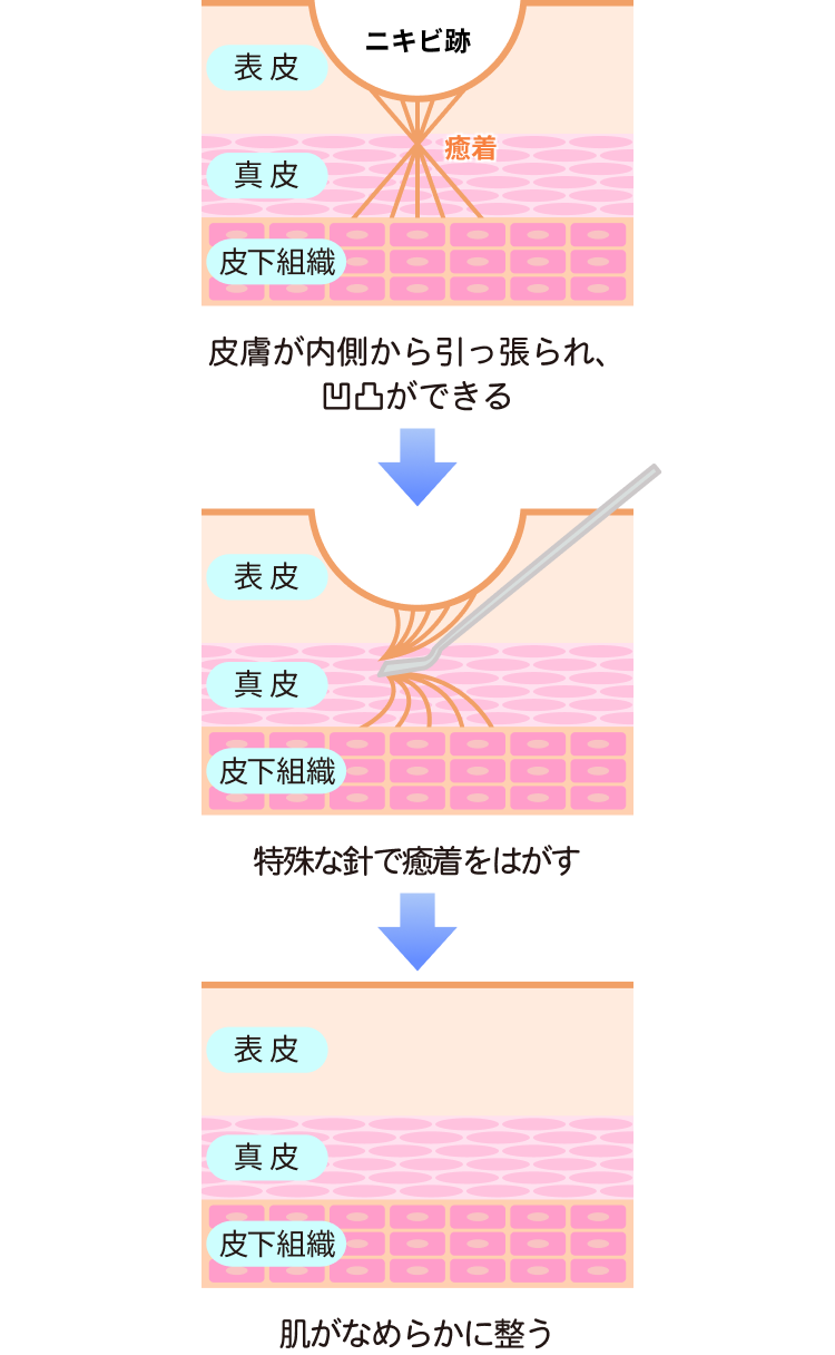 CO2レーザー・ヒアルロン酸の併用で治療効果を高めることが可能