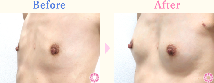 年代：30代 施術名：ヒアルロン酸による豊胸術 施術前後｜【公式】東京形成美容外科