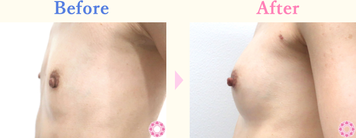 年代：30代 施術名：ヒアルロン酸による豊胸術 施術前後｜【公式】東京形成美容外科