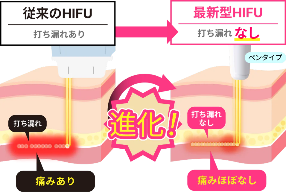 リフトアップHIFU（ハイフ）