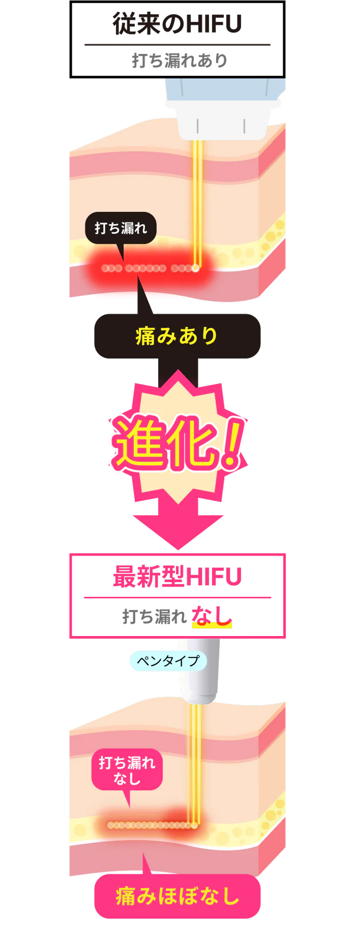 リフトアップHIFU（ハイフ）