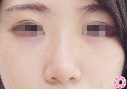 年代：20代 施術名：プチ隆鼻術（ヒアルロン酸） 施術後｜【公式】東京形成美容外科